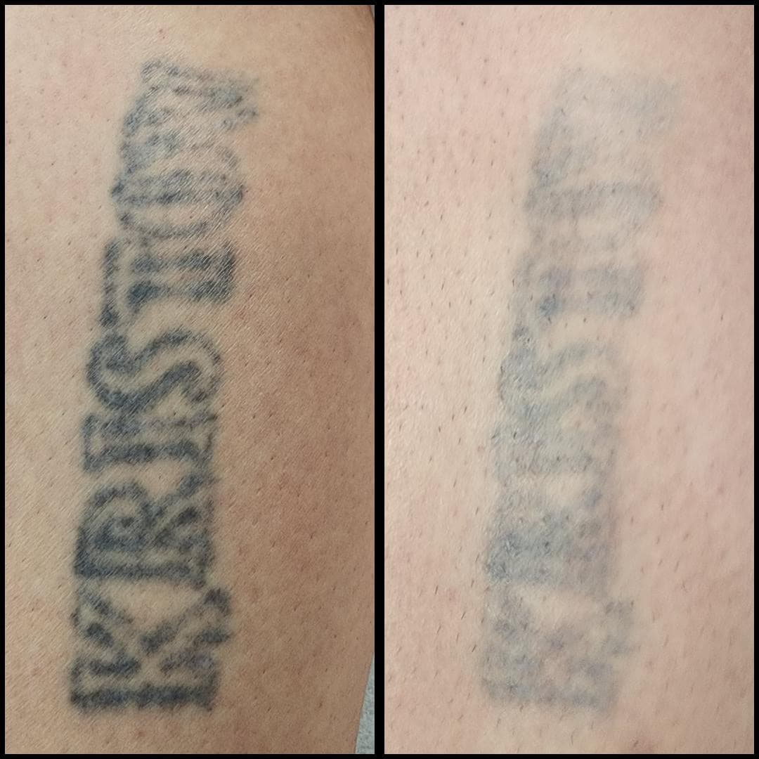 Tattoo removal. The fade between an appointment. By Kat