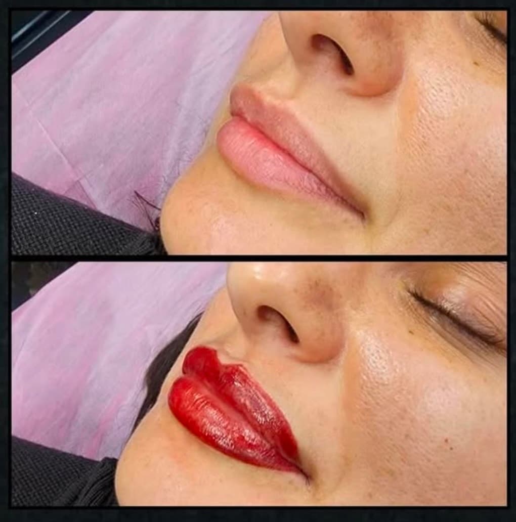Large tattoo laser removal by Kat